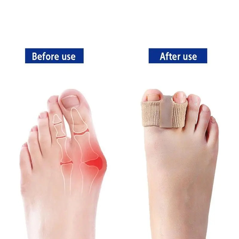 Silicone Toe Separators for Bunion Relief by Springtok - All-Day Comfort for Walking, Running, and Hiking | Bunion Corrector and Toe Sleeves Healthcare