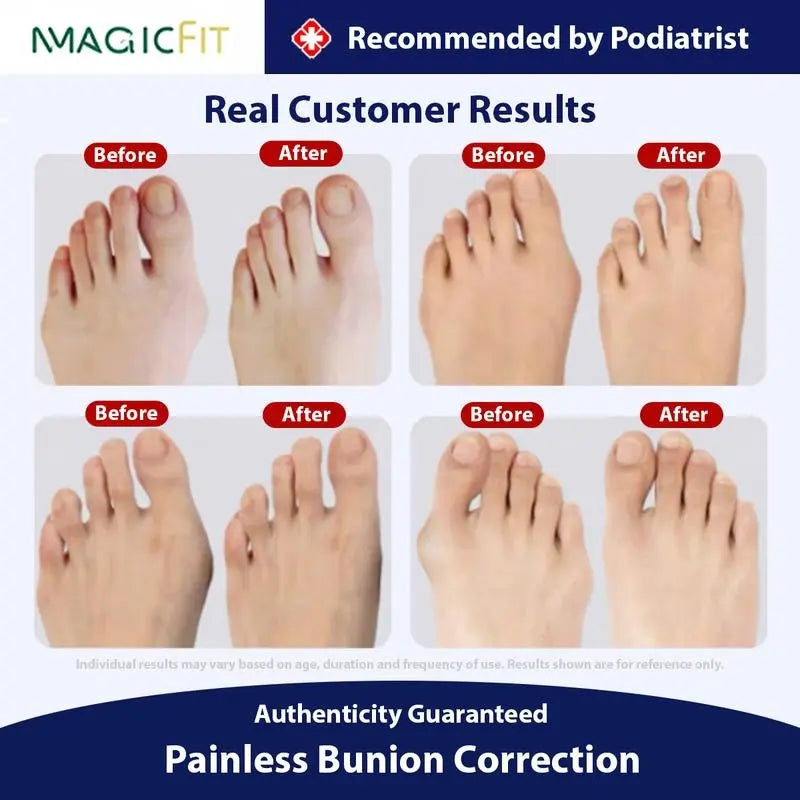 Silicone Toe Separators for Bunion Relief by Springtok - All-Day Comfort for Walking, Running, and Hiking | Bunion Corrector and Toe Sleeves Healthcare